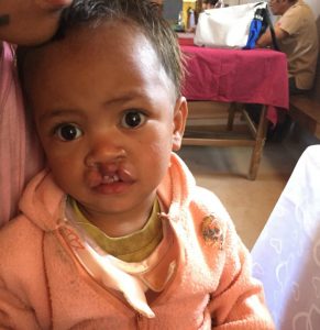 This young girl received surgery to correct her cleft lip through cooperation with the local Lutheran church and a generous LCMS donor.